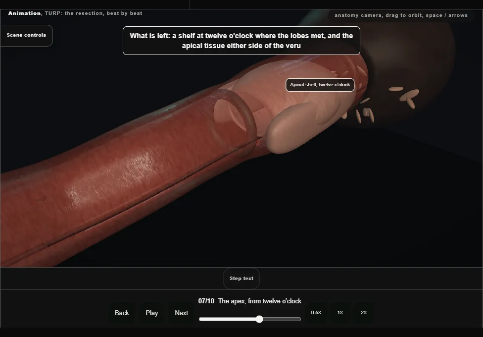 TURP: the resection, beat by beat. Step 7: The apex, from twelve o'clock. Captured frame from the interactive animation.