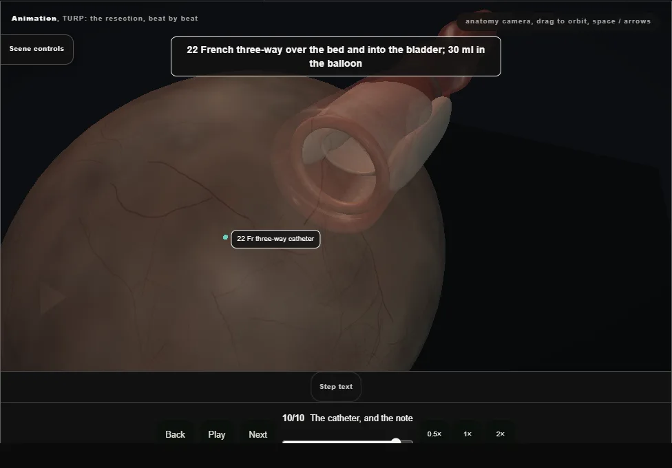 TURP: the resection, beat by beat. Step 10: The catheter, and the note. Captured frame from the interactive animation.