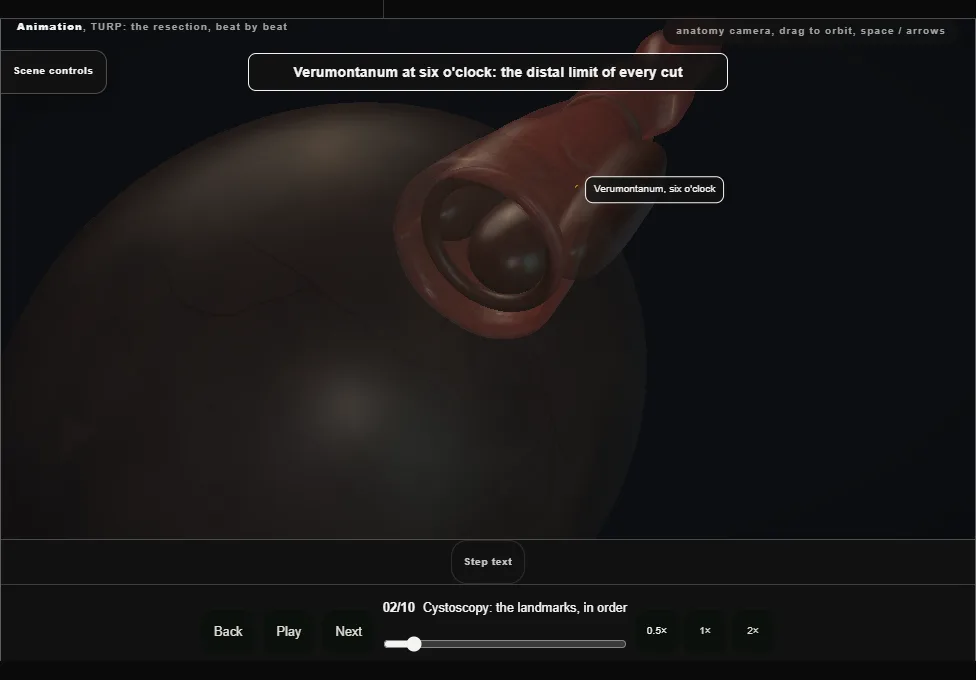 TURP: the resection, beat by beat. Step 2: Cystoscopy: the landmarks, in order. Captured frame from the interactive animation.