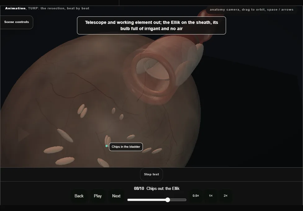 TURP: the resection, beat by beat. Step 8: Chips out: the Ellik. Captured frame from the interactive animation.