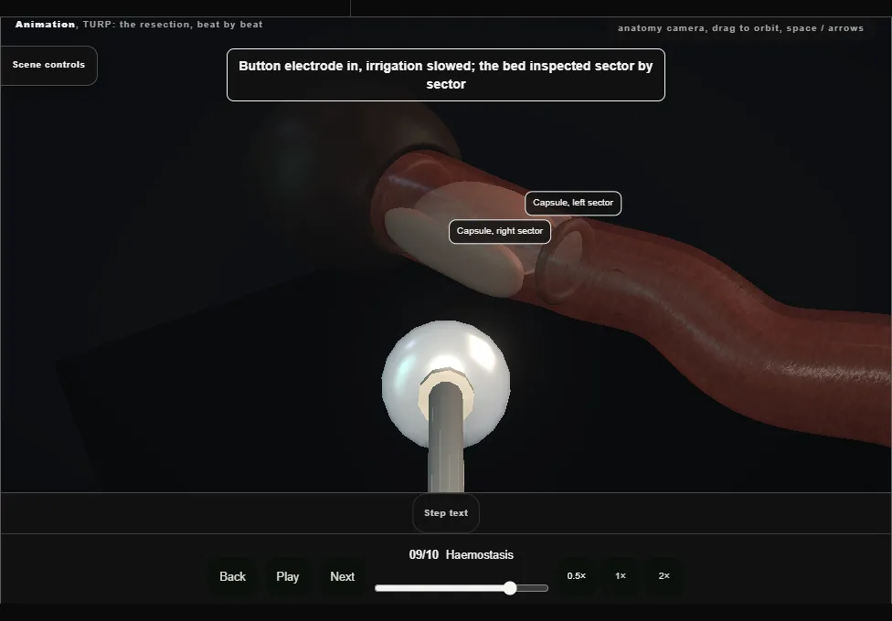 TURP: the resection, beat by beat. Step 9: Haemostasis. Captured frame from the interactive animation.