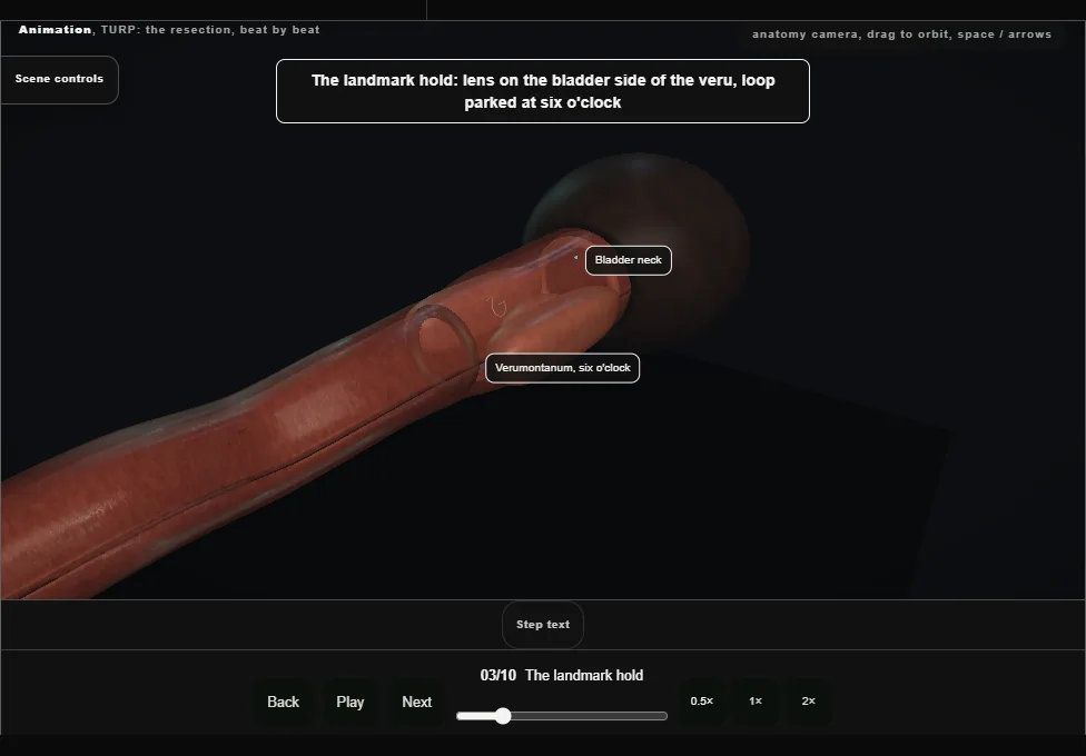 TURP: the resection, beat by beat. Step 3: The landmark hold. Captured frame from the interactive animation.