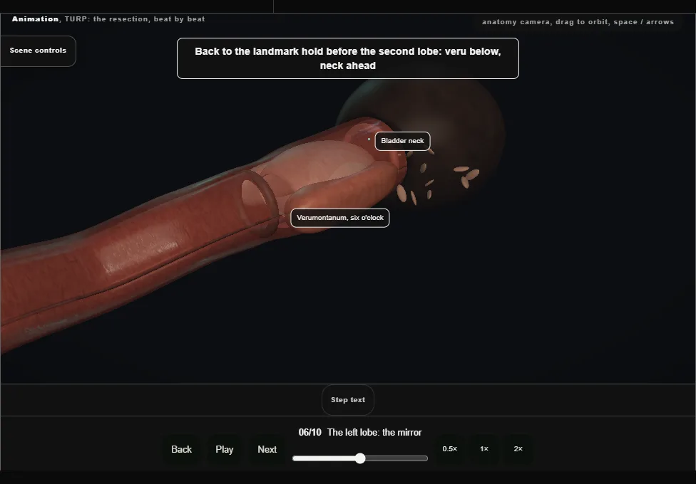 TURP: the resection, beat by beat. Step 6: The left lobe: the mirror. Captured frame from the interactive animation.