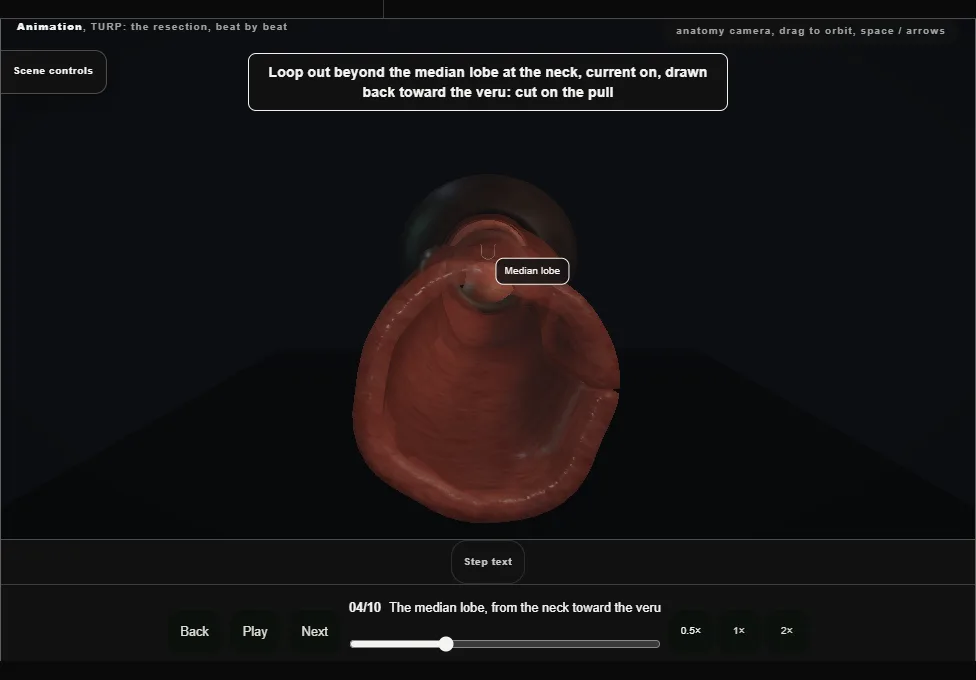 TURP: the resection, beat by beat. Step 4: The median lobe, from the neck toward the veru. Captured frame from the interactive animation.