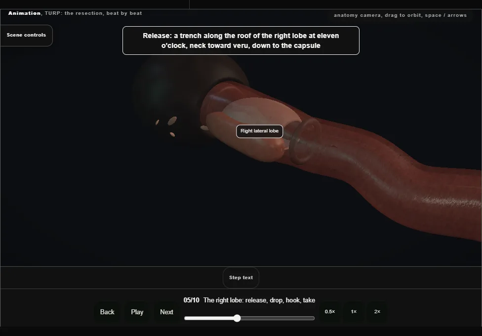 TURP: the resection, beat by beat. Step 5: The right lobe: release, drop, hook, take. Captured frame from the interactive animation.