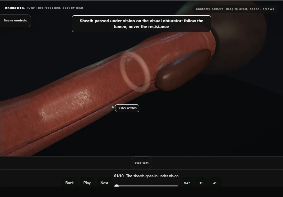 TURP: the resection, beat by beat. Step 1: The sheath goes in under vision. Captured frame from the interactive animation.