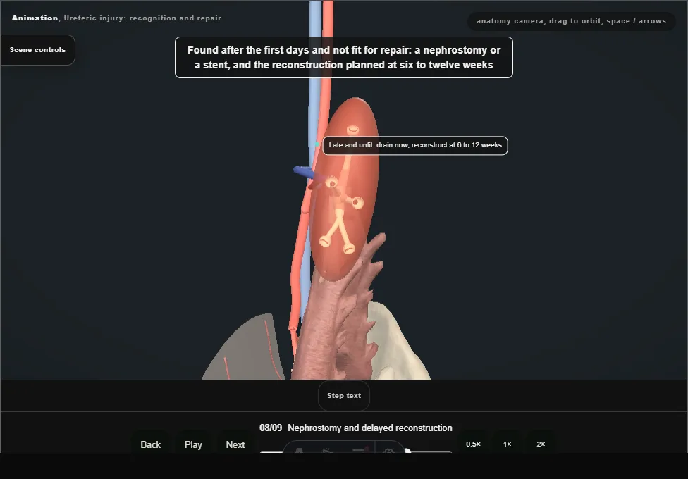 Ureteric injury: recognition and repair. Step 8: Nephrostomy and delayed reconstruction. Captured frame from the interactive animation.
