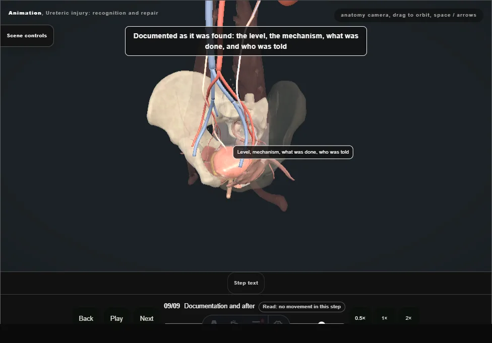 Ureteric injury: recognition and repair. Step 9: Documentation and after. Captured frame from the interactive animation.