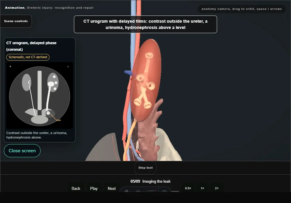 Ureteric injury: recognition and repair. Step 5: Imaging the leak. Captured frame from the interactive animation.