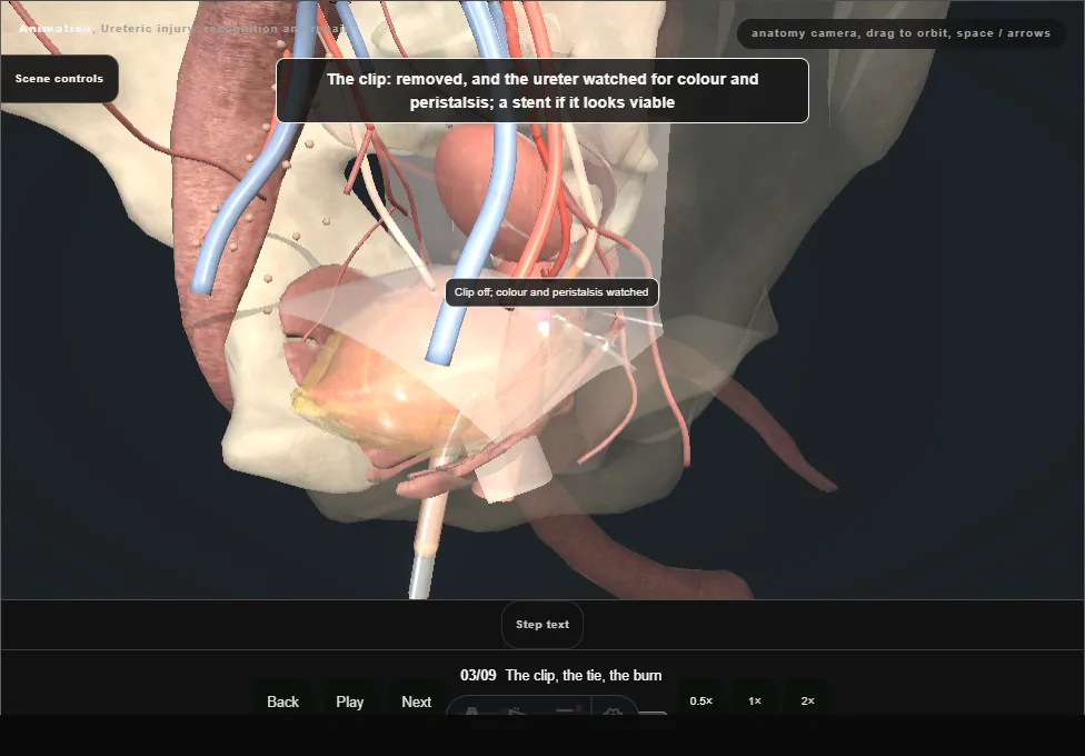 Ureteric injury: recognition and repair. Step 3: The clip, the tie, the burn. Captured frame from the interactive animation.