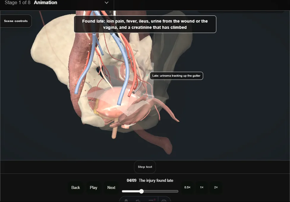 Ureteric injury: recognition and repair. Step 4: The injury found late. Captured frame from the interactive animation.