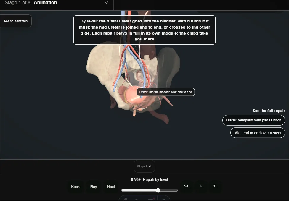 Ureteric injury: recognition and repair. Step 7: Repair by level. Captured frame from the interactive animation.