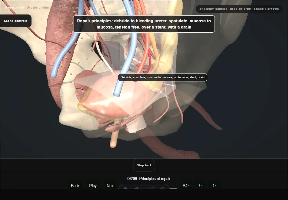 Ureteric injury: recognition and repair. Step 6: Principles of repair. Captured frame from the interactive animation.