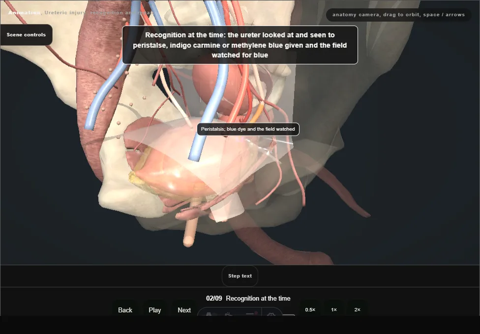 Ureteric injury: recognition and repair. Step 2: Recognition at the time. Captured frame from the interactive animation.