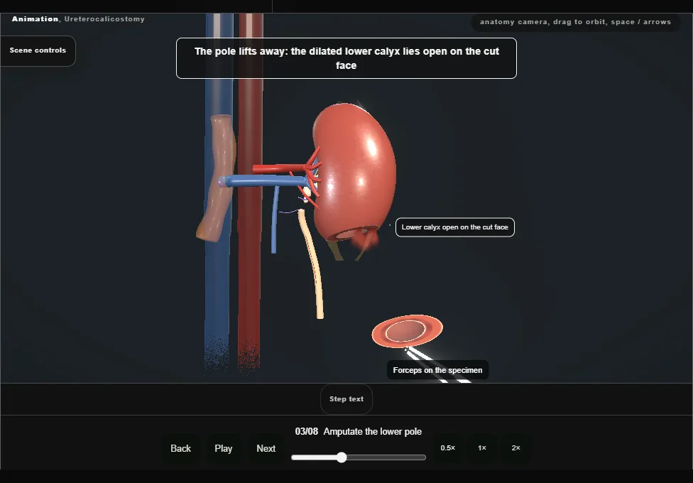 Ureterocalicostomy. Step 3: Amputate the lower pole. Captured frame from the interactive animation.