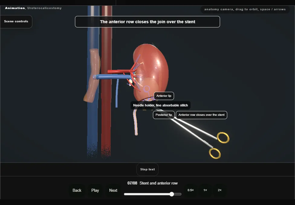 Ureterocalicostomy. Step 7: Stent and anterior row. Captured frame from the interactive animation.