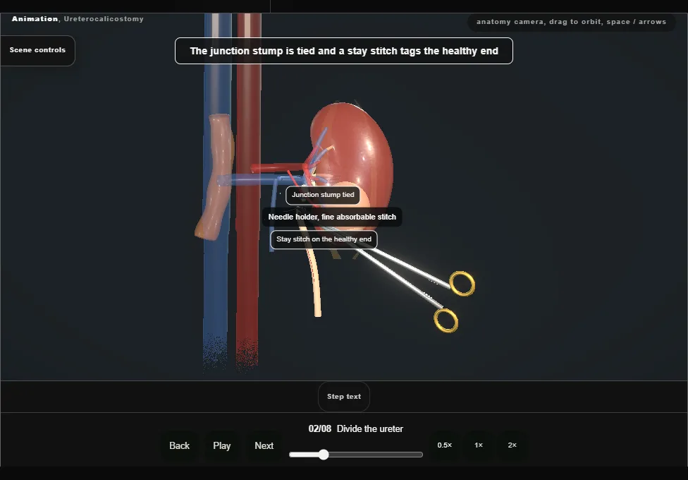 Ureterocalicostomy. Step 2: Divide the ureter. Captured frame from the interactive animation.