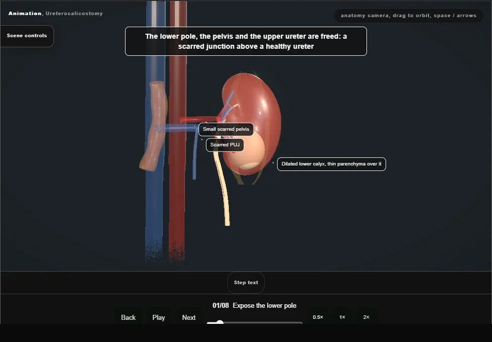 Ureterocalicostomy. Step 1: Expose the lower pole. Captured frame from the interactive animation.