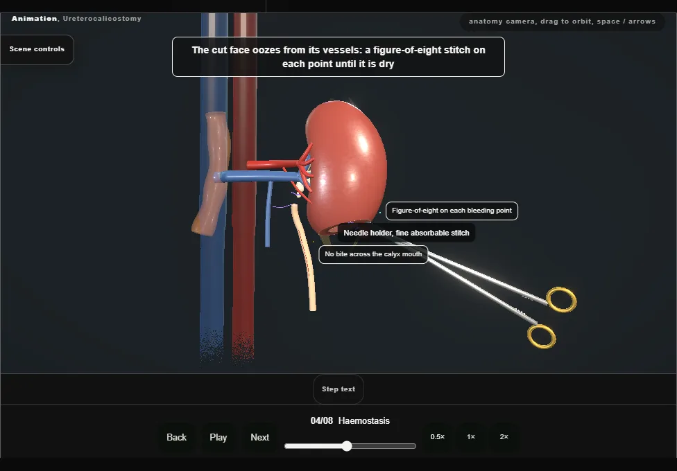 Ureterocalicostomy. Step 4: Haemostasis. Captured frame from the interactive animation.
