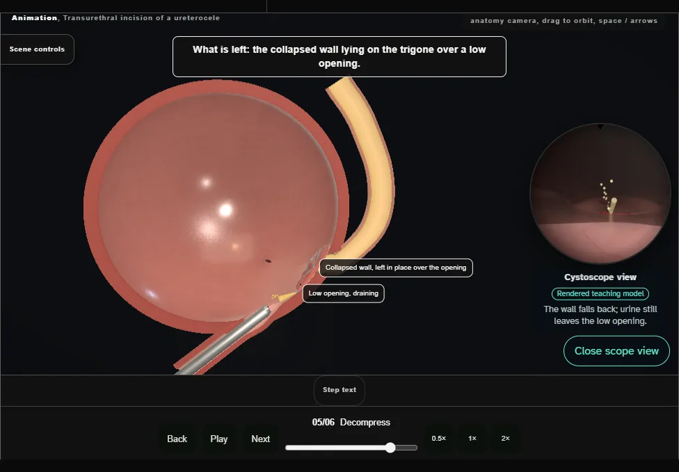Transurethral incision of a ureterocele. Step 5: Decompress. Captured frame from the interactive animation.