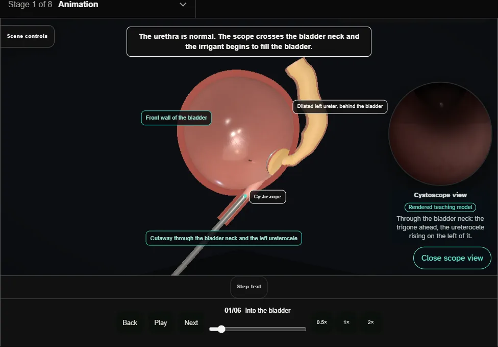 Transurethral incision of a ureterocele. Step 1: Into the bladder. Captured frame from the interactive animation.