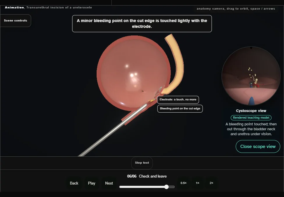 Transurethral incision of a ureterocele. Step 6: Check and leave. Captured frame from the interactive animation.
