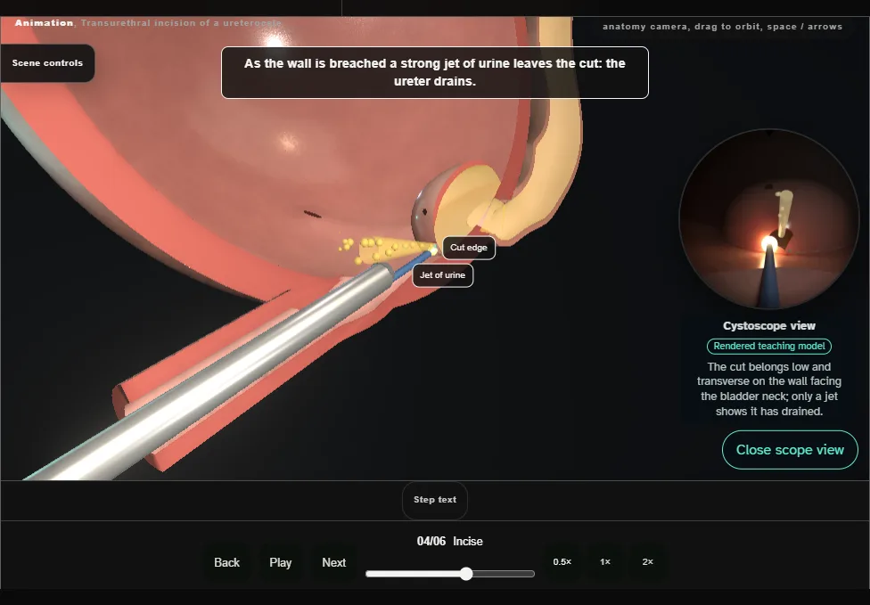 Transurethral incision of a ureterocele. Step 4: Incise. Captured frame from the interactive animation.
