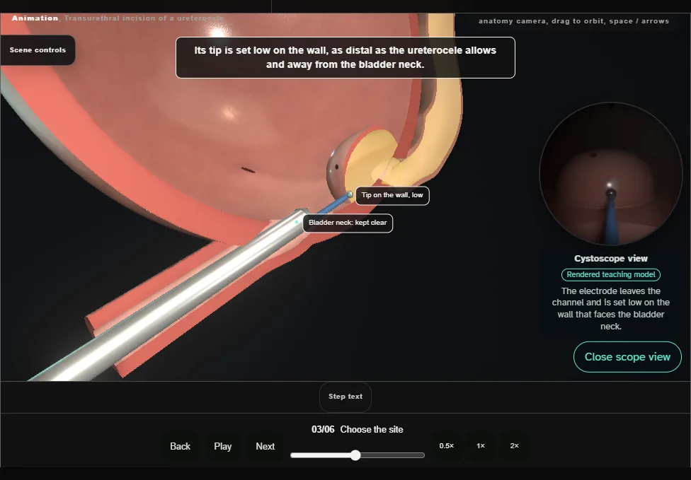 Transurethral incision of a ureterocele. Step 3: Choose the site. Captured frame from the interactive animation.