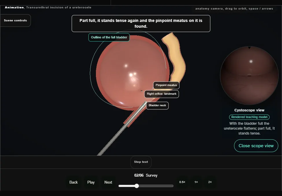 Transurethral incision of a ureterocele. Step 2: Survey. Captured frame from the interactive animation.