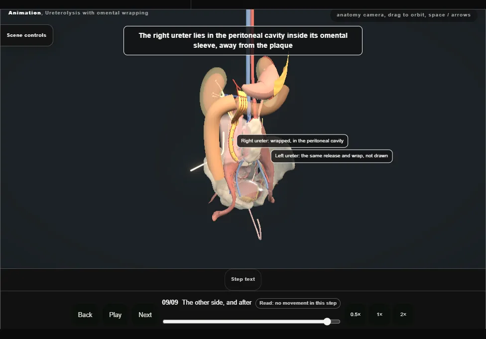 Ureterolysis with omental wrapping. Step 9: The other side, and after. Captured frame from the interactive animation.