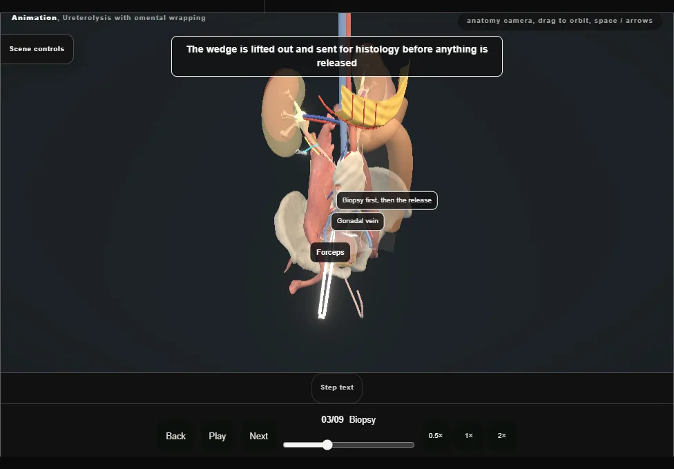 Ureterolysis with omental wrapping. Step 3: Biopsy. Captured frame from the interactive animation.
