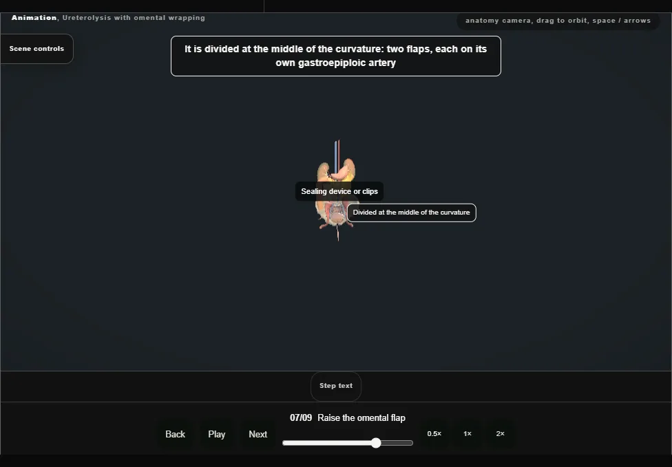 Ureterolysis with omental wrapping. Step 7: Raise the omental flap. Captured frame from the interactive animation.