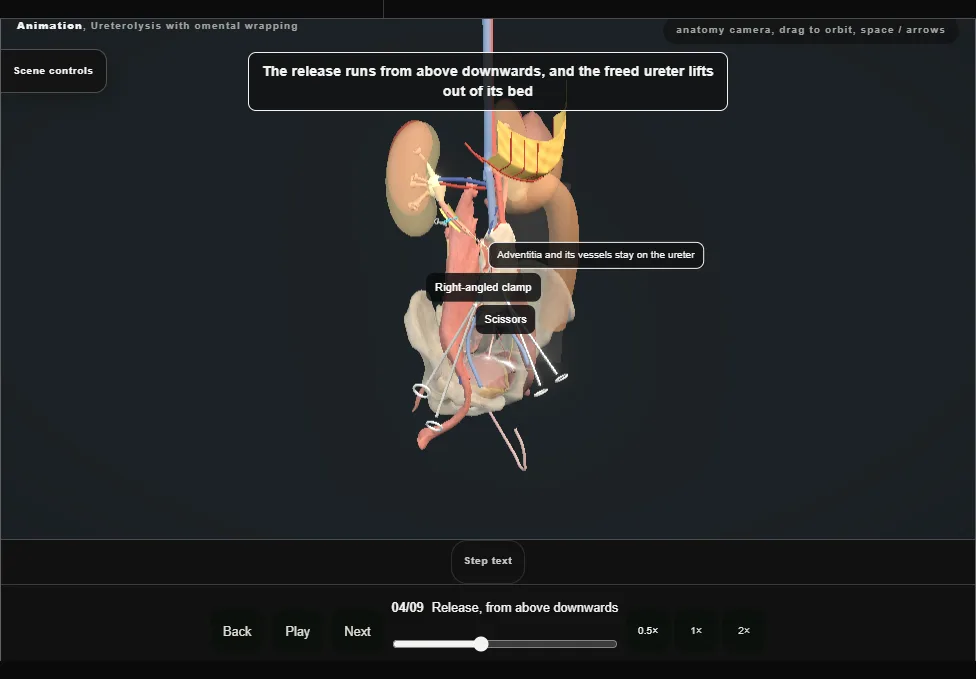 Ureterolysis with omental wrapping. Step 4: Release, from above downwards. Captured frame from the interactive animation.