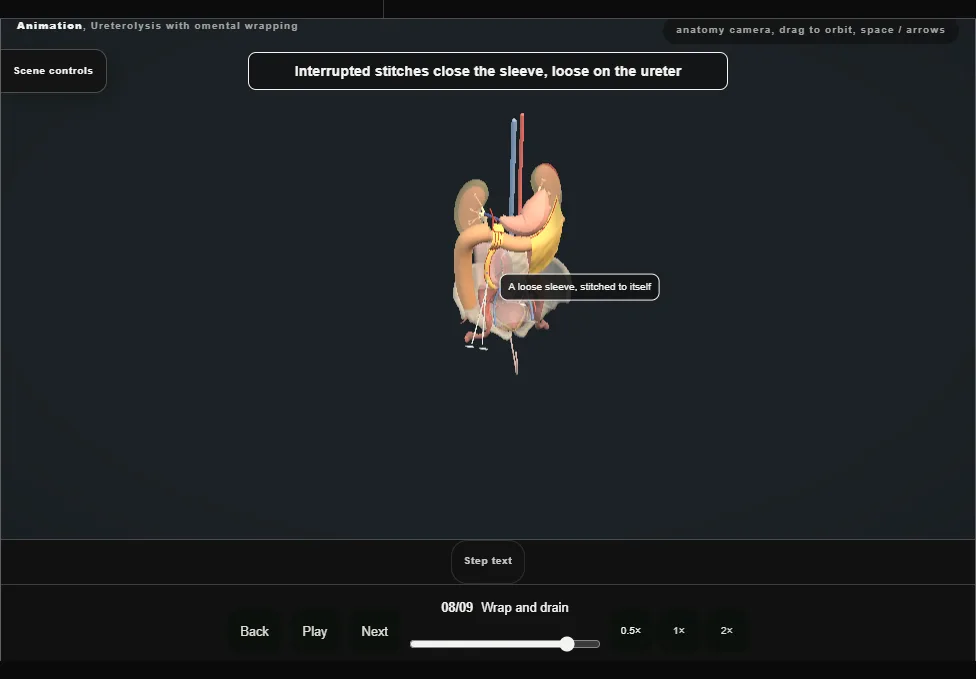 Ureterolysis with omental wrapping. Step 8: Wrap and drain. Captured frame from the interactive animation.