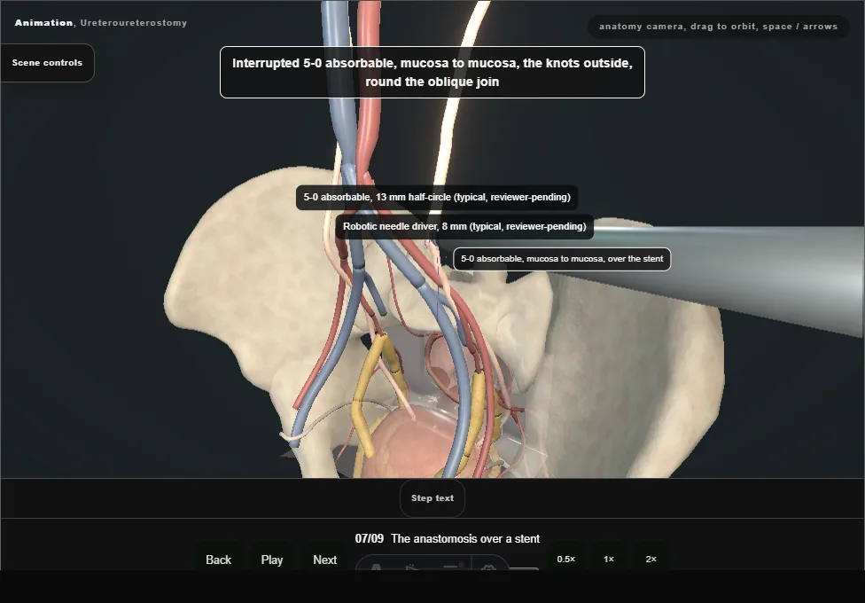 Ureteroureterostomy. Step 7: The anastomosis over a stent. Captured frame from the interactive animation.