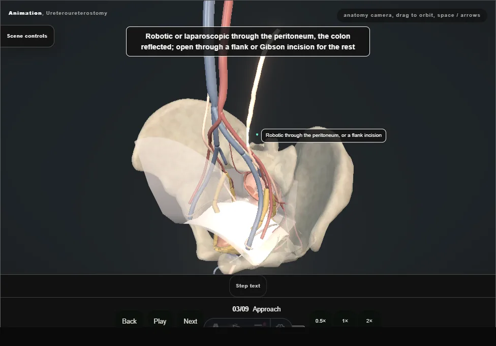 Ureteroureterostomy. Step 3: Approach. Captured frame from the interactive animation.