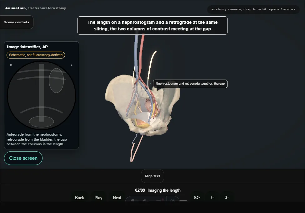 Ureteroureterostomy. Step 2: Imaging the length. Captured frame from the interactive animation.