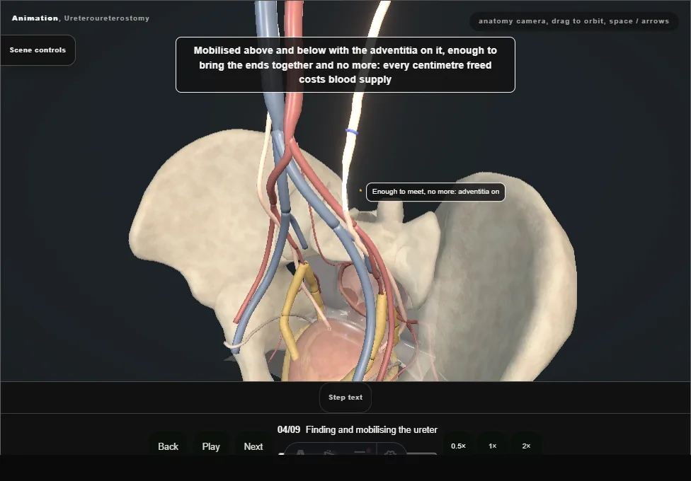 Ureteroureterostomy. Step 4: Finding and mobilising the ureter. Captured frame from the interactive animation.