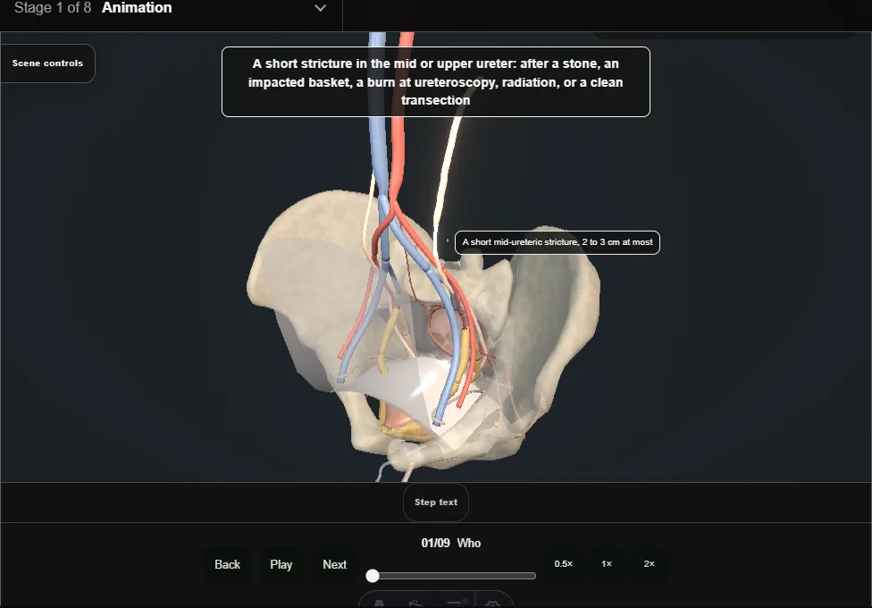 Ureteroureterostomy. Step 1: Who. Captured frame from the interactive animation.