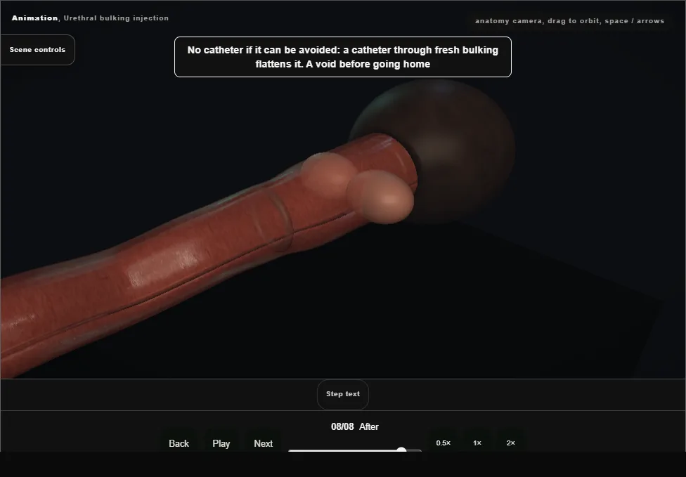 Urethral bulking injection. Step 8: After. Captured frame from the interactive animation.