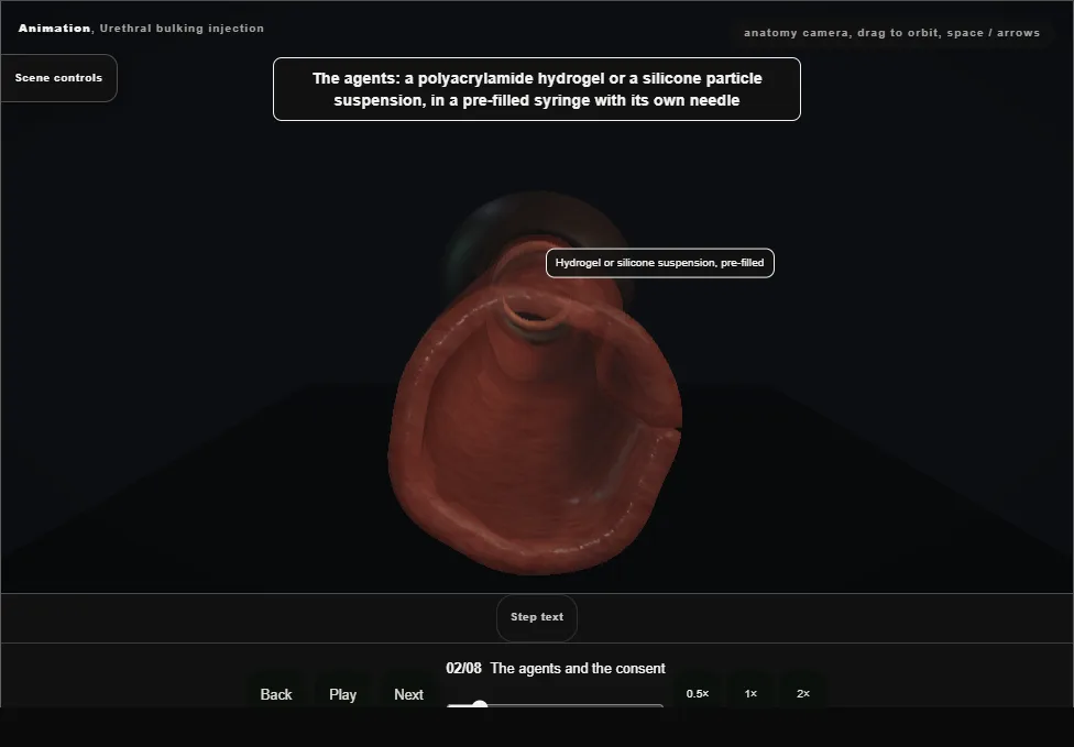 Urethral bulking injection. Step 2: The agents and the consent. Captured frame from the interactive animation.
