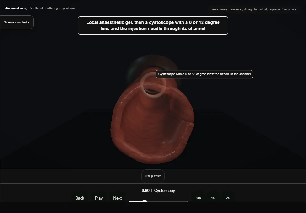 Urethral bulking injection. Step 3: Cystoscopy. Captured frame from the interactive animation.