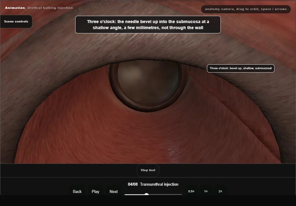 Urethral bulking injection. Step 4: Transurethral injection. Captured frame from the interactive animation.