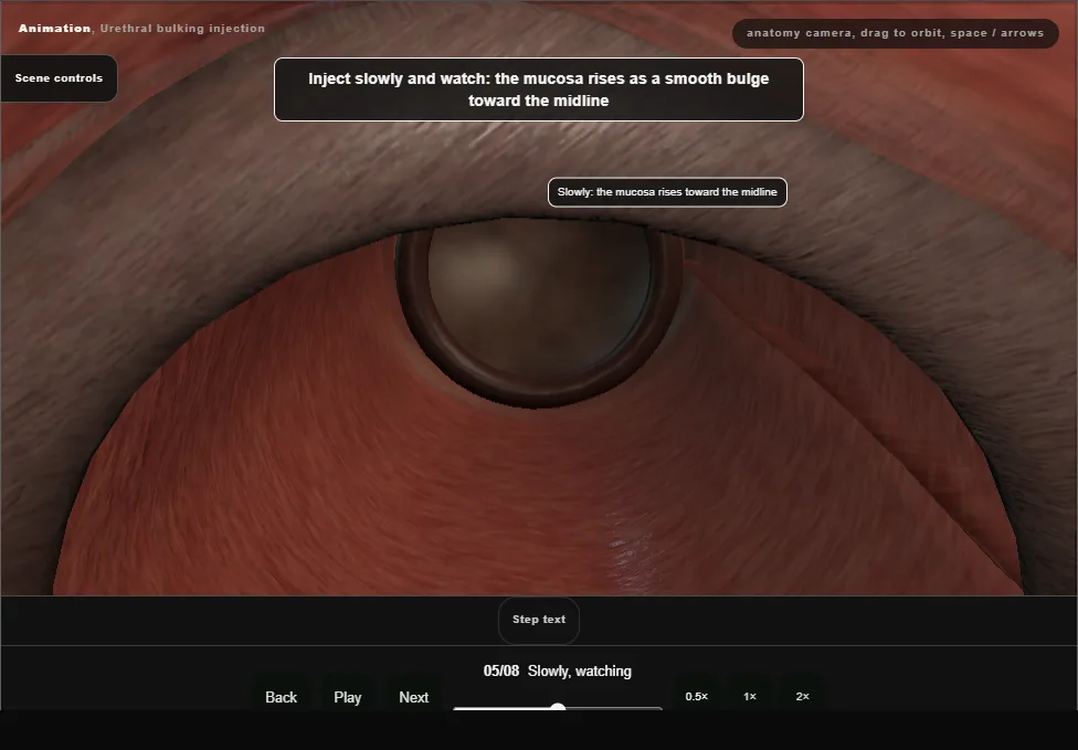 Urethral bulking injection. Step 5: Slowly, watching. Captured frame from the interactive animation.