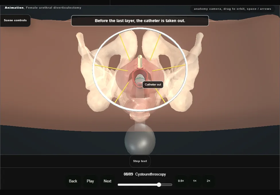 Female urethral diverticulectomy. Step 8: Cystourethroscopy. Captured frame from the interactive animation.