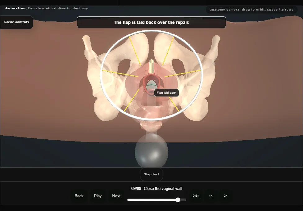 Female urethral diverticulectomy. Step 9: Close the vaginal wall. Captured frame from the interactive animation.