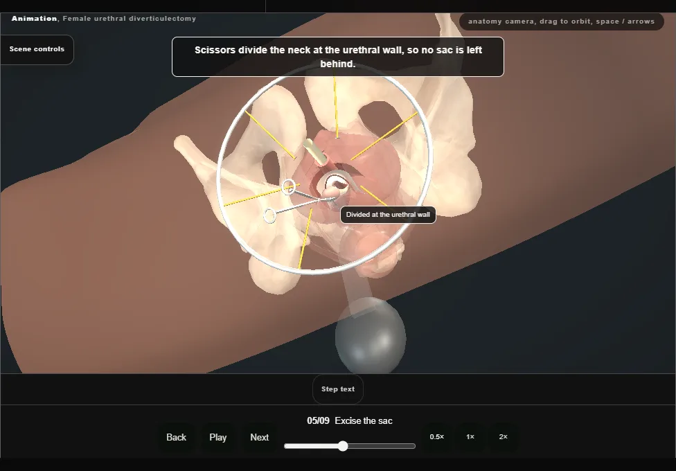 Female urethral diverticulectomy. Step 5: Excise the sac. Captured frame from the interactive animation.