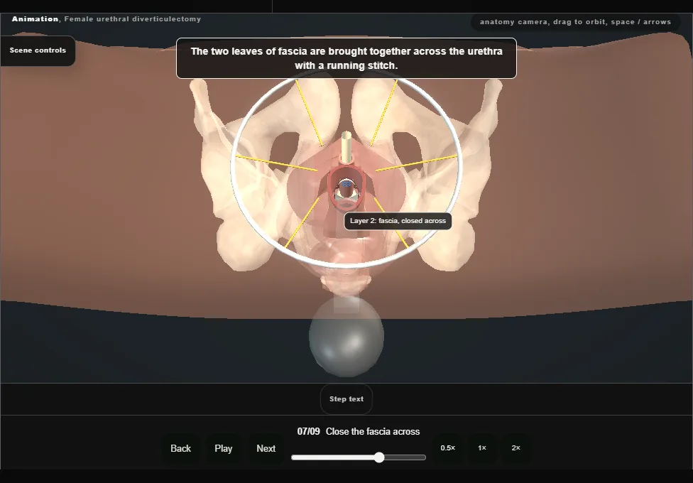 Female urethral diverticulectomy. Step 7: Close the fascia across. Captured frame from the interactive animation.