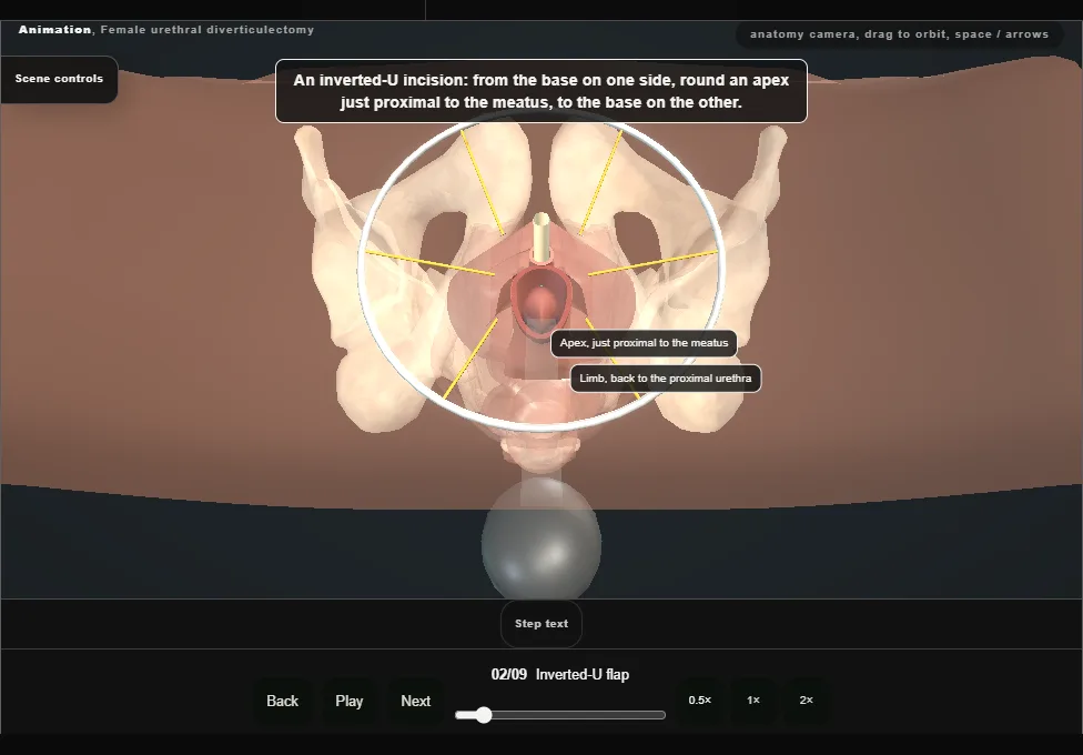 Female urethral diverticulectomy. Step 2: Inverted-U flap. Captured frame from the interactive animation.