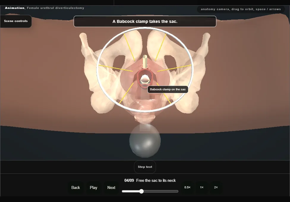 Female urethral diverticulectomy. Step 4: Free the sac to its neck. Captured frame from the interactive animation.